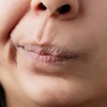 Understanding scars on lip is crucial for individuals seeking to overcome their physical and emotional effects. This article guides prevention, treatment, and emotional wellbeing wellbeing.