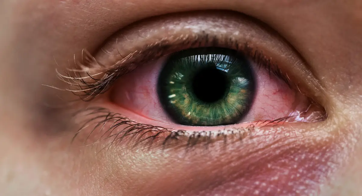 Red eyes after cannabis use, affectionately known as "weed eyes," are a common and often persistent nuisance for many enthusiasts