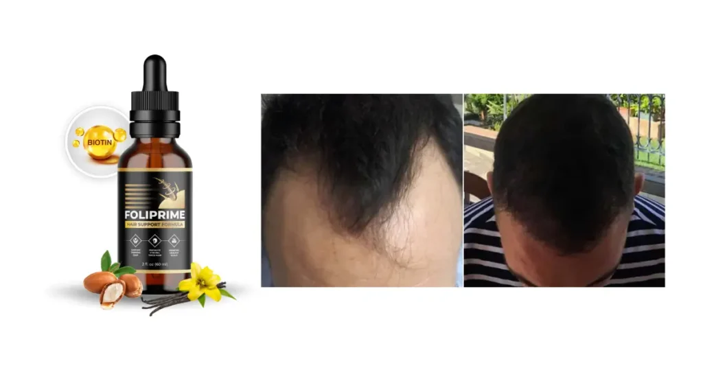 Foliprime Reviews Before and after