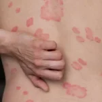 How To Get Rid Of Eczema Scars Naturally And Professionally