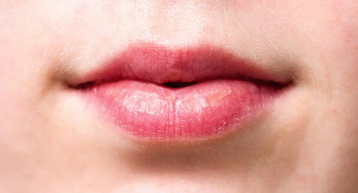 How to Get Rid of Scars on Lips