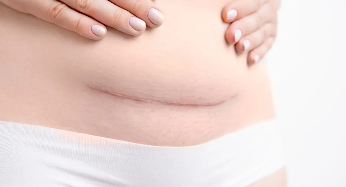 how-to-get-rid-of-hanging-belly-after-c-section