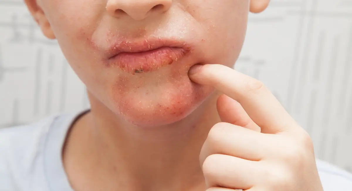 Signs Of Perioral Dermatitis Healing